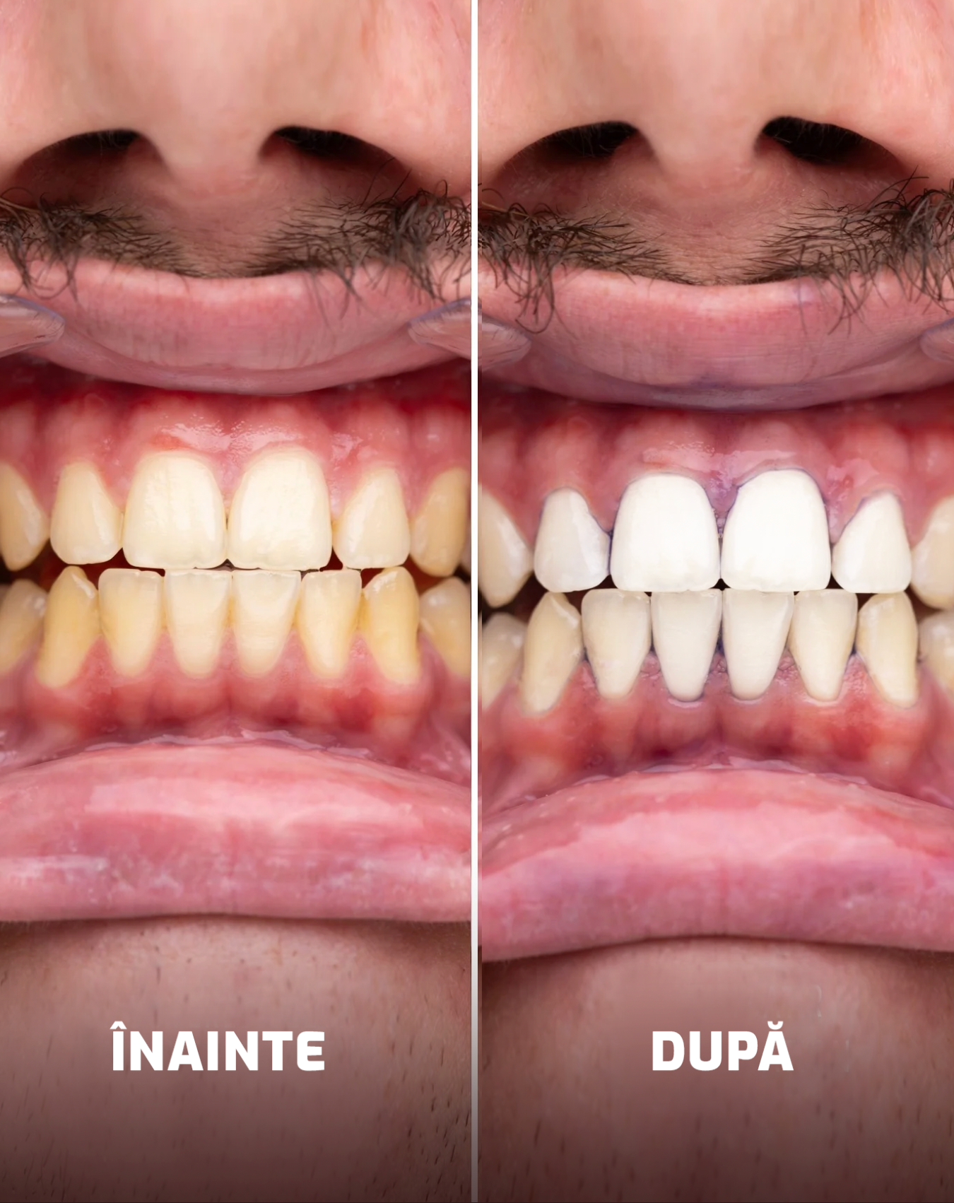 Benzi pentru Albirea Dinților