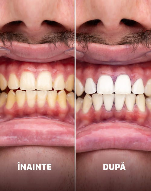 Benzi pentru Albirea Dinților